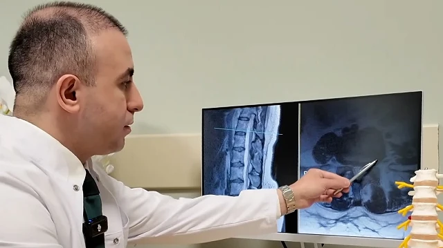 Bel Fıtığı Hakkında Bilinmesi Gerekenler: Ameliyat Son Çare Olmalı